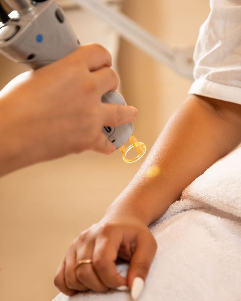 A laser hair removal handpiece being passed over a client's forearm